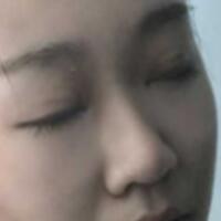 在成都魅麗經(jīng)緯做單眼皮變雙眼皮整形恢復(fù)過程和對比圖分享