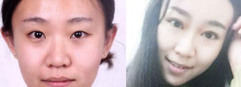 雙眼皮切割前后對比圖，單眼皮變雙眼皮整形恢復(fù)過程