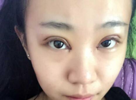 單眼皮變雙眼皮整形恢復(fù)過程和對比圖分享