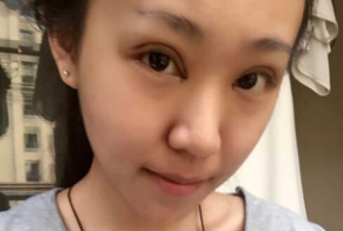 單眼皮變雙眼皮整形恢復(fù)過程和對比圖