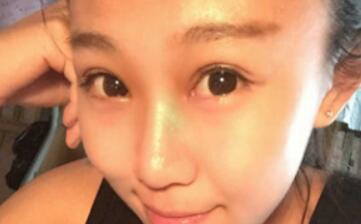 單眼皮變雙眼皮整形恢復(fù)過程和對比圖