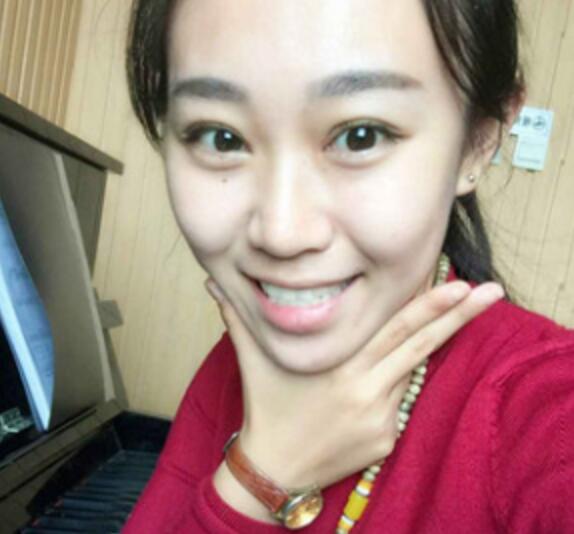 單眼皮變雙眼皮整形恢復(fù)過程和對比圖