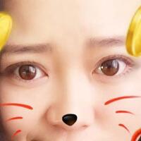 割雙眼皮前后對比圖和恢復(fù)過程——成都魅麗經(jīng)緯整形醫(yī)院