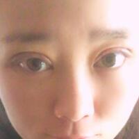 割雙眼皮前后對比圖和恢復(fù)過程——成都魅麗經(jīng)緯整形醫(yī)院