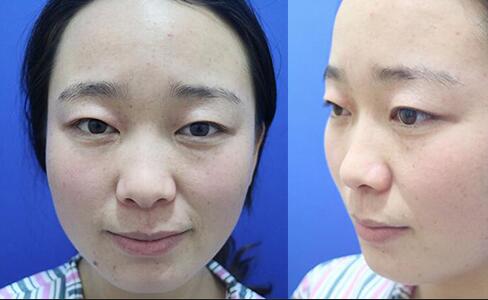 割雙眼皮前后對比圖和恢復(fù)過程