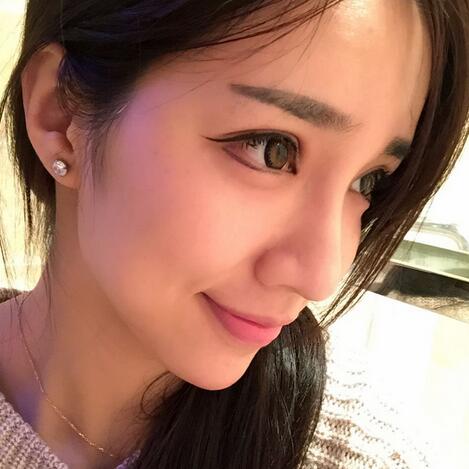 切開(kāi)雙眼皮恢復(fù)過(guò)程分享 杭州東方做雙眼皮2個(gè)月