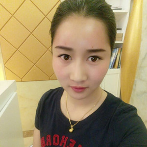 武漢美都張召醫(yī)生做的自體脂肪豐額頭+太陽穴，真實(shí)案例分享