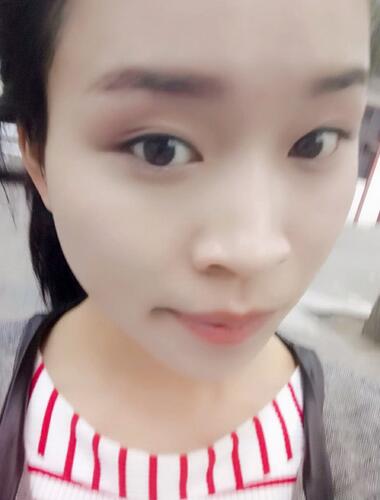 長(zhǎng)安醫(yī)院盧丙侖教授V-line瓜子臉手術(shù)前后對(duì)比