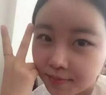 雙眼皮整形前后對(duì)比圖，單眼皮變雙眼皮整容日記