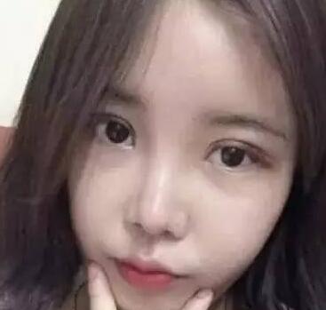 雙眼皮整形前后對(duì)比圖，單眼皮變雙眼皮整容日記