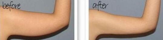 吸脂減肥瘦手臂前后對(duì)比圖