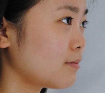 隆鼻整形價格和真實恢復(fù)期圖片