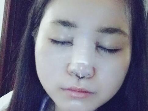 隆鼻整形價格和真實恢復(fù)期圖片