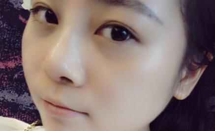 隆鼻整形價格和真實恢復(fù)期圖片