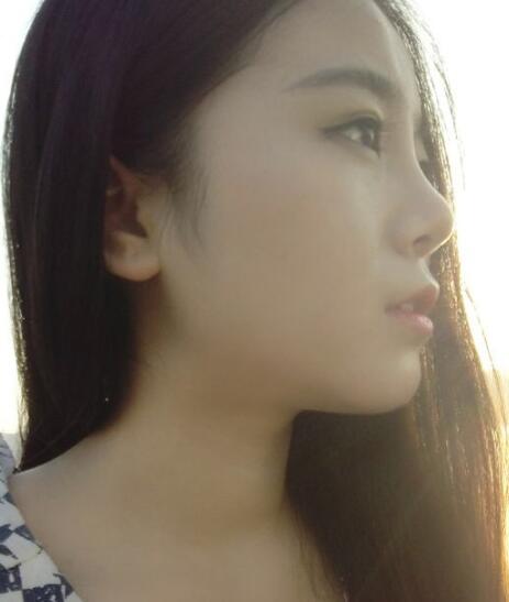 隆鼻整形價格和真實恢復(fù)期圖片