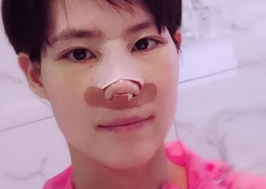 杭州悅可整形醫(yī)院做隆鼻失敗修復(fù)恢復(fù)過程和對比圖分享