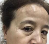 去抬頭紋方法？杭州悅可整容推薦注射瘦臉去抬頭紋魚尾紋