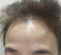 去抬頭紋方法？杭州悅可整容推薦注射瘦臉去抬頭紋魚尾紋