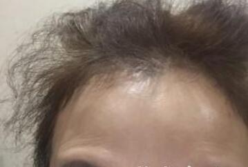 去抬頭紋很好的方法？注射瘦臉去抬頭紋魚尾紋