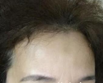 去抬頭紋很好的方法？注射瘦臉去抬頭紋魚尾紋