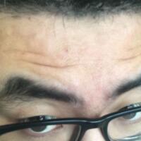 男生注射注射瘦臉去除抬頭紋魚尾紋案例分享——杭州悅可整形