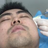 男生注射注射瘦臉去除抬頭紋魚尾紋案例分享——杭州悅可整形