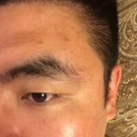 男生注射注射瘦臉去除抬頭紋魚尾紋案例分享——杭州悅可整形