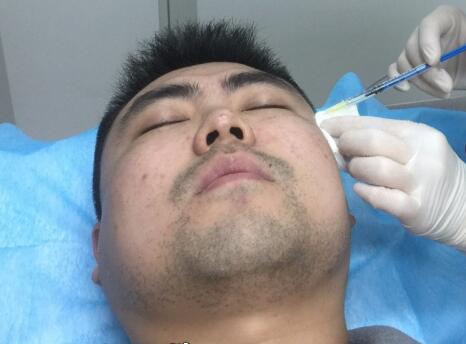 男生注射注射瘦臉去除抬頭紋魚尾紋案例分享