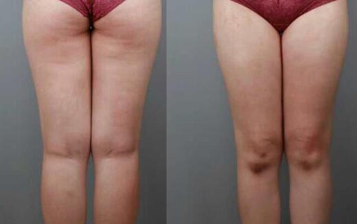 吸脂減肥瘦大腿前后對(duì)比圖，光纖溶脂瘦大腿較有的方法真實(shí)案例