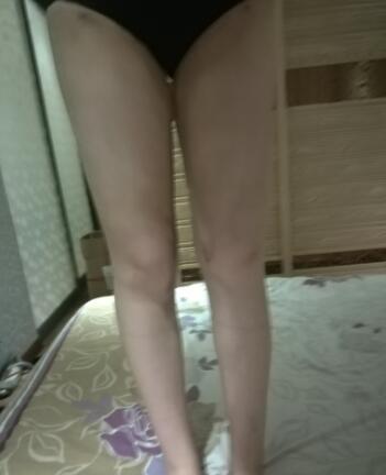 吸脂瘦大腿前后對比圖,水動力吸脂瘦大腿真實案例多對比圖經(jīng)歷