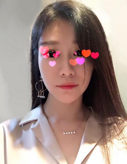 北京磨下頜角整形的果圖