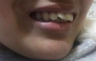 在成都圣貝牙科醫(yī)院做了兩顆純鈦烤瓷牙價格4800元