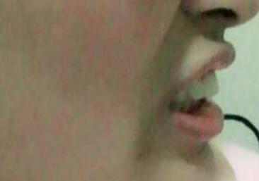 在成都圣貝牙科醫(yī)院做了兩顆純鈦烤瓷牙價格4800元