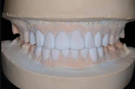 成都圣貝口腔醫(yī)院做了全冠修復(fù)，牙齒排齊美白前后對比果圖