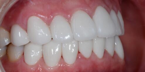 成都圣貝口腔醫(yī)院做了全冠修復(fù)，牙齒排齊美白前后對比果圖