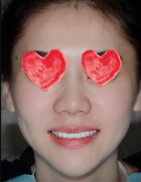 成都圣貝口腔醫(yī)院做了全冠修復(fù)，牙齒排齊美白前后對比果圖