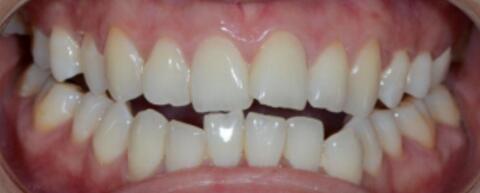 成都圣貝口腔醫(yī)院做了全冠修復(fù)，牙齒排齊美白前后對比果圖