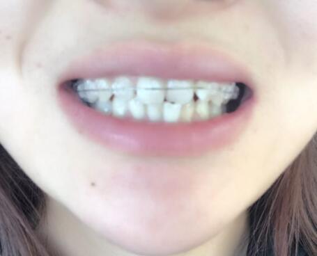 戴隱形牙套矯正牙齒前后對比圖——成都圣貝牙科醫(yī)院