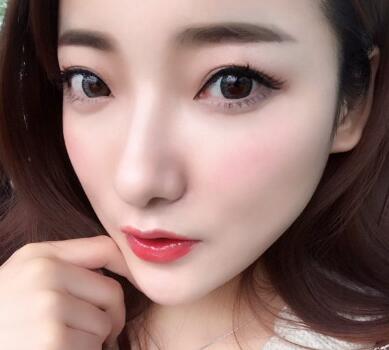 戴隱形牙套矯正牙齒前后對比圖——成都圣貝牙科醫(yī)院