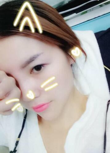 隆鼻整形一個月恢復期圖片 武漢壹加壹隆鼻整形案例