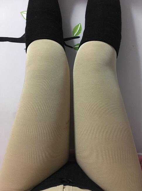 水動(dòng)力吸脂減肥瘦大腿手術(shù)前后對(duì)比圖和恢復(fù)過(guò)程