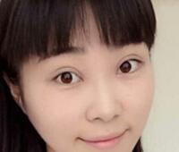 時(shí)光整形醫(yī)院做的割雙眼皮手術(shù)價(jià)格5200元 雙眼皮對(duì)比圖恢復(fù)過(guò)程