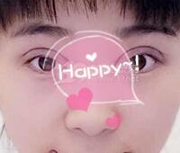 時(shí)光整形醫(yī)院做的割雙眼皮手術(shù)價(jià)格5200元 雙眼皮對(duì)比圖恢復(fù)過(guò)程