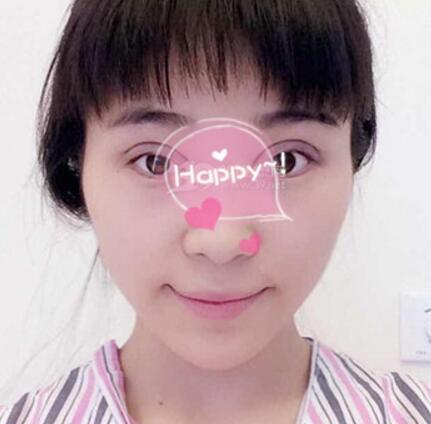 割雙眼皮手術(shù)價(jià)格 雙眼皮對比圖恢復(fù)過程