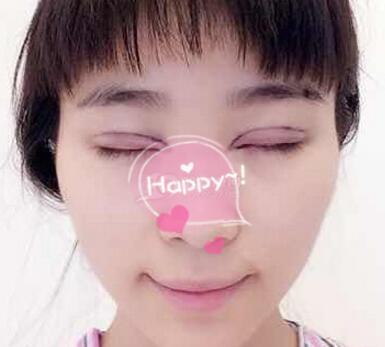 割雙眼皮手術(shù)價(jià)格 雙眼皮對比圖恢復(fù)過程