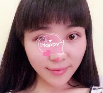 割雙眼皮手術(shù)價(jià)格 雙眼皮對比圖恢復(fù)過程