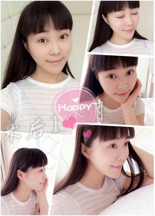 割雙眼皮手術(shù)價(jià)格 雙眼皮對比圖恢復(fù)過程