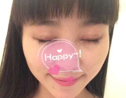 割雙眼皮手術(shù)價(jià)格 雙眼皮對比圖恢復(fù)過程