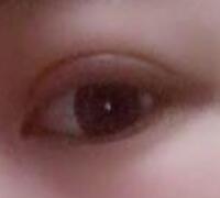 切開(kāi)雙眼皮+開(kāi)眼角手術(shù)前后對(duì)比圖恢復(fù)過(guò)程 昆山時(shí)光整形醫(yī)院