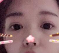 切開(kāi)雙眼皮+開(kāi)眼角手術(shù)前后對(duì)比圖恢復(fù)過(guò)程 昆山時(shí)光整形醫(yī)院